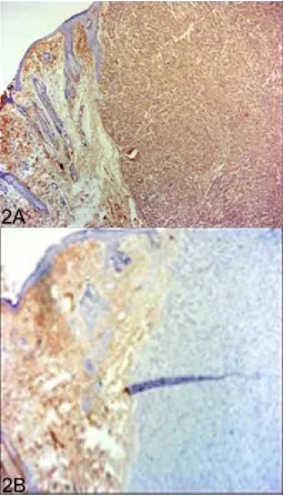 Figure 5. Sarcoma, skin, rabbit. A. Immunohistochemistry using a mouse monoclonal antibody to α-smooth muscle actin labels both the tumor and the adjacent dermis