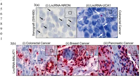 Figure 3: Paraffin embedded different human cancer tissues Z probe stained for different lncRNAs