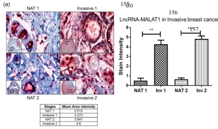 Figure 4: LncRNA-MALAT in different stages of CRC. Paraffin embedded different stages of colorectal cancer 