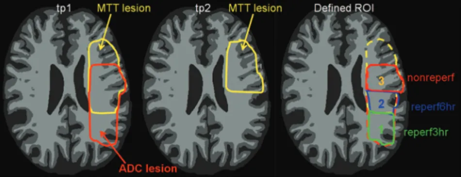 Figure 1), representing an ADC lesion that reperfused before tp1 imaging ( ⬍3 hours). ROI (2) reperf_6hour was defined as voxels with abnormal ADC and MTT at tp1 but normal MTT at tp2 (labeled as