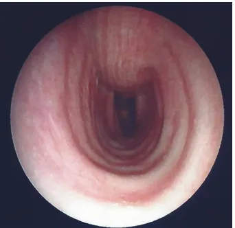 Figure 3: Bronchoscopic image of the patient’s right main bronchusshowing unequal nodular protrusions of the mucosa.