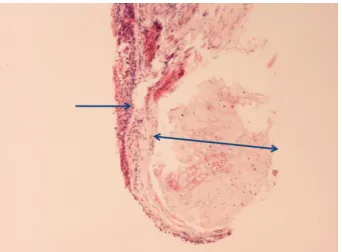 Figure 4: Histopathologic image of patient’s bronchial wall showingpresence of cartilaginous tissue in submucosa, compatible withtracheobronchopathia osteochondroplastica (Hematoxylin-Eosinstain ×40).