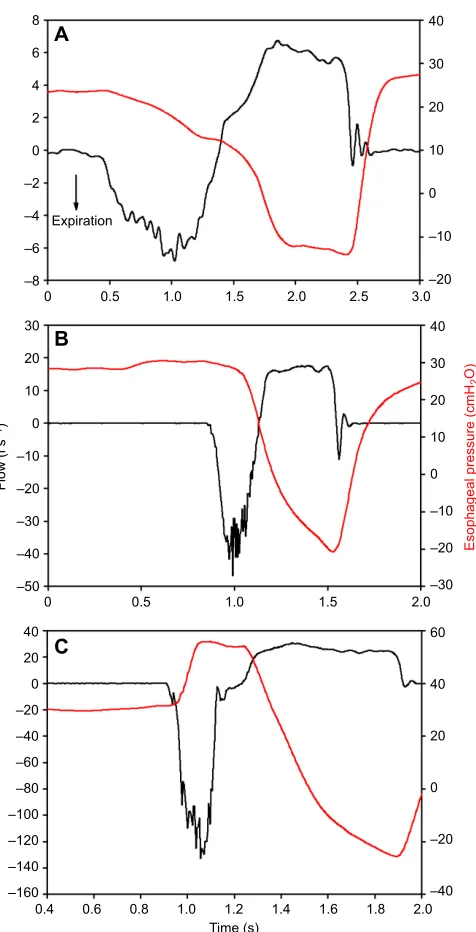 Fig. 5. Respiratory flow and esophageal pressure during normal andforced breaths in a bottlenose dolphin (show normal (A,B) and forced (C) breaths, where expiratory flow is negative.Esophageal pressure is shown in red and respiratory flow is in black