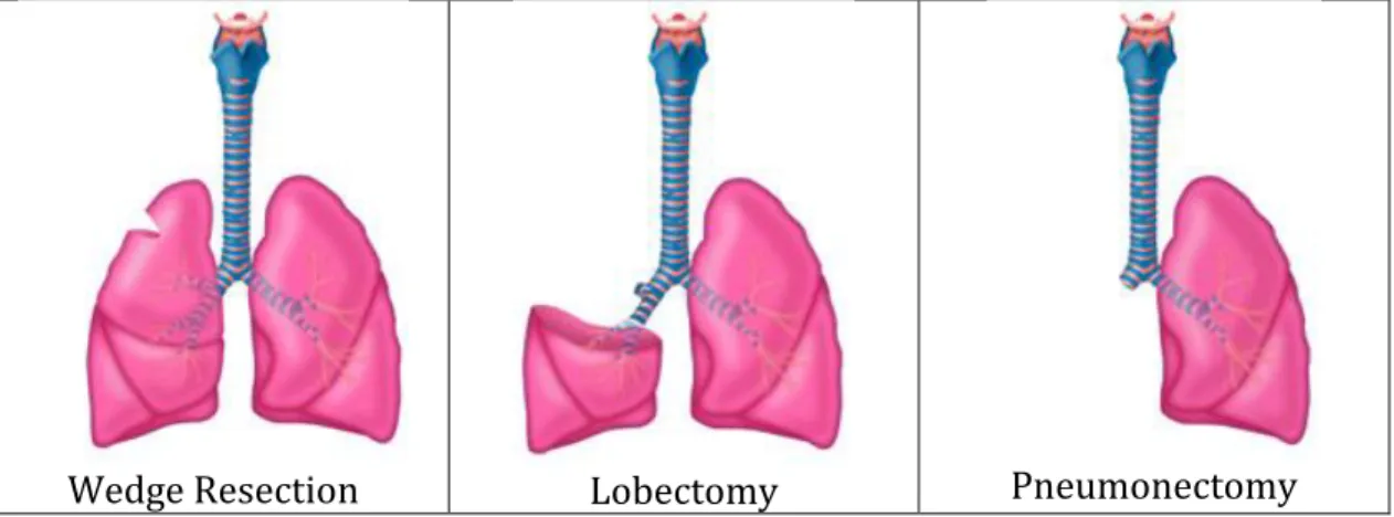 Figure 7: Lung Surgeries.  From http://www.cts.usc.edu/lpg-typesoflungsurgery.html 