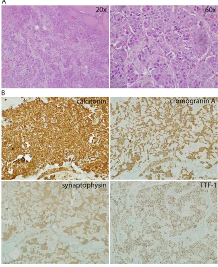 Figure 1. A. Hematoxylin-Eosin (H&E) staining of MTC nodule at 20x and 60x magnification