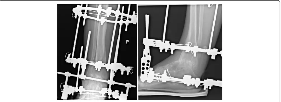 Fig. 1 Patient with ankle joint arthrodesis with Ilizarov fixator stabilization