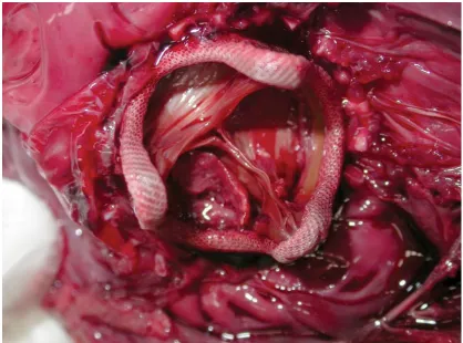Figure 3: Post-mortem picture of thrombus on valve (day four postoperatively, case 8) 