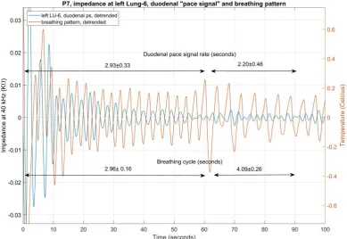 Figure 3. Shows the impedance at left LU-6 on patient 7, after exercise. A bandpass filter was applied to show the duodenal pace signal, as captured within the impedance; which is superimposed on the breathing pattern, as captured at the nostril