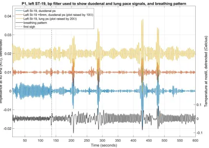 Figure 4. Shows the impedance at left ST-19 on patient 1, after exercise. A bandpass filter was applied to 