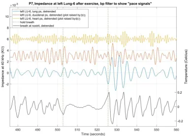 Figure 1. Shows the impedance at left LU-6 on patient 7, after exercise. Bandpass filters were applied to 