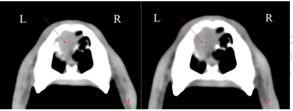 Figure 5. Pre-treatment and post-treatment CT images of Case 3. 5.1: Pre-treatment transverse; 5.2: post-treatment transverse