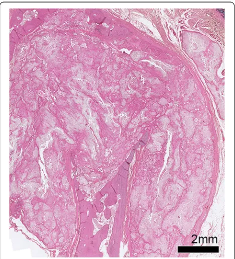 Fig. 4 Tophus associated with structural damage in a right littlefinger distal interphalangeal joint from a cadaveric donor withmicroscopically proven gout