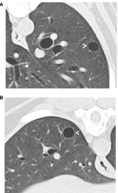 Figure 2. Examples of lung cysts. A) 10mm diameter cyst (arrowhead) in the left caudal lobe of a 