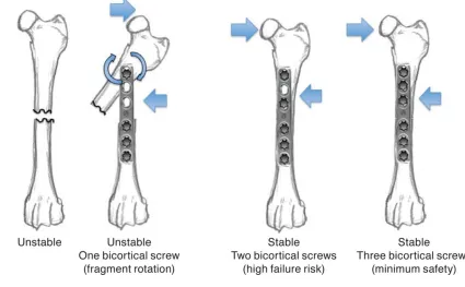 Figure 2: Three screw doctrine: One bicortical screw per segment allows rotation. Two 