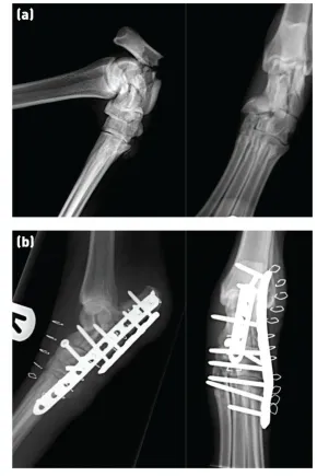 Figure 5: (a) Short comminuted calcaneal fracture. (b) The fracture was double plated, 