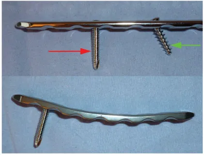 Figure 7: Locking Compression Plate (LCP, DePuy Synthes) allows for placement of 