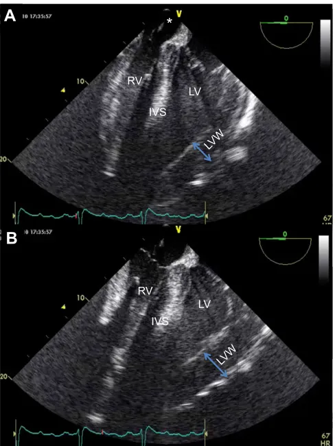 Fig. 3. Recording of arterial and left and the right ventricle pressure in ananaesthetised giraffe