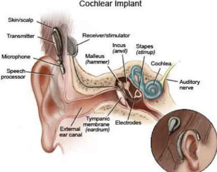 Figure 2.4  Behind the ear (BTE) cochlear implant  