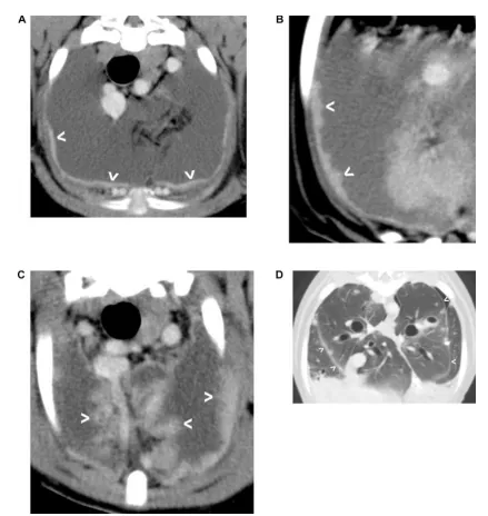 Figure 1. Examples of diffuse pleural thickening. A) Slight diffuse thickening of the parietal 