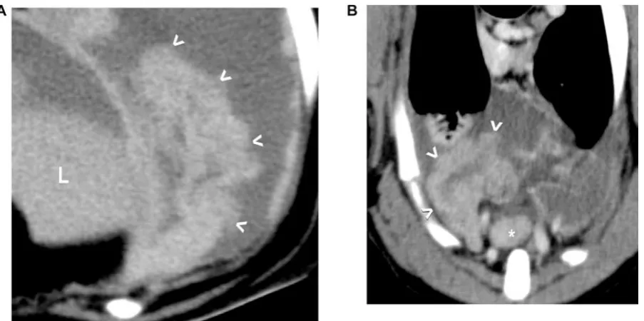 Figure 3. Examples of pannus (A and B) in dogs with pyothorax. In each instance, the 
