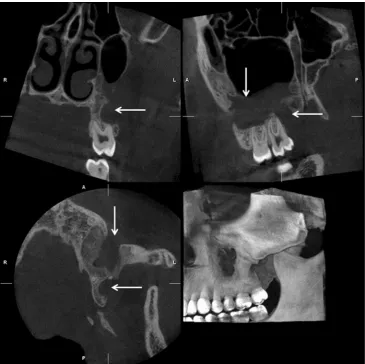 Fig. 13 A large KCOT has beenoperated on in the left maxillarysinus. CBCT examinationrevealed a recurrence distally to d.27, which was histopathologicallyproven (horizontal arrows)