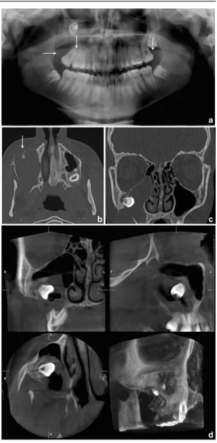 Fig. 2 a PTG reveals cranialagainst the palate.dislocation of d. 18 into the rightmaxillary sinus with a cysticlesion causing expansion of thesinus walls