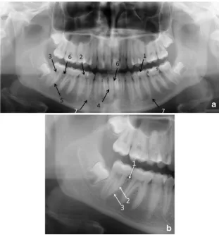 Fig. 5 A PTG demonstratingdeciduous dentition with allunerupted permanent teeth andtheir follicles (except thirdmolars) in a 5-year- and 9-month-old male
