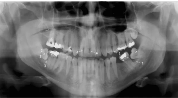 Fig. 7 A PTG demonstrating frequent pathological conditions of teethand periodontal (bony supportive) structures: 1