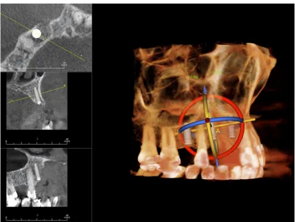 Fig. 10 Virtual implant treatment planning with CBCT data: software can help implant treatment planning through simulation and 3D reformation.(Courtesy Jari Mauno.)
