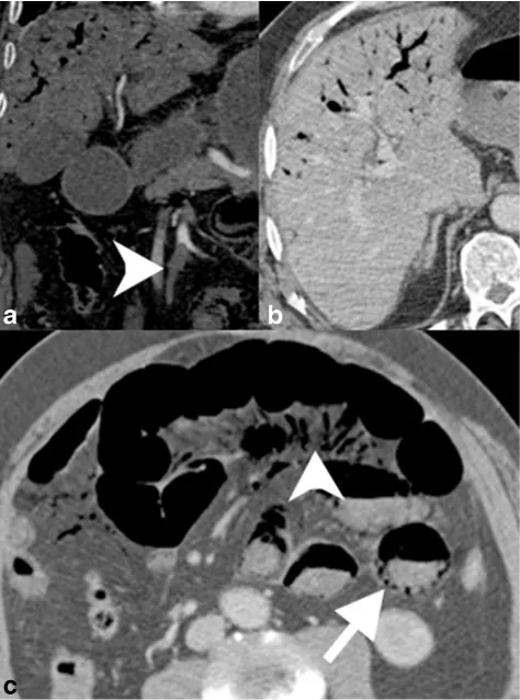 Fig. 13 SMV thrombosis with mesenteric congestion. a Contrast-enhanced coronal reformatted CT of an occlusive thrombus in the SMV(white arrowhead) extending to the portal confluence