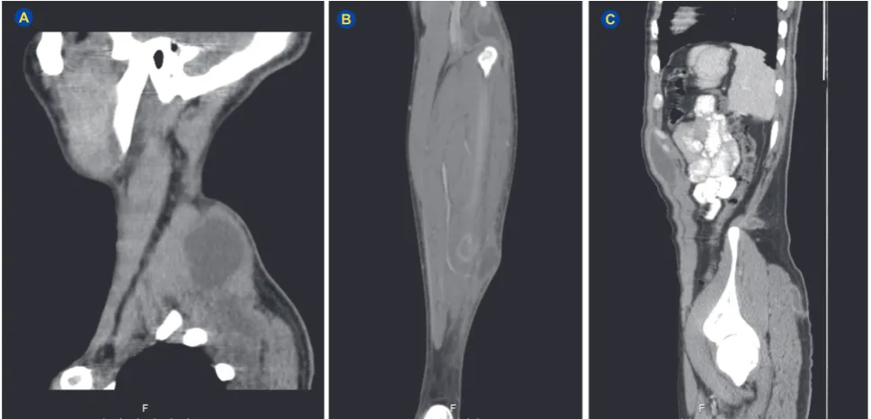 Figure 2 – Intra-muscular and soft tissue abscesses – CT scan at admission. surface of lower third of the left leg, in the soleus muscle, communicating with a bigger one located in the subcutaneous fat AND on the lateral surface of the upper third of the left leg, involving the proximal insertion of the plantaris muscle, communicating with a subcutaneous collection in the medial surface of the leg; (A) Posterior surface of the right cervical region; (B) Posterior (C) Left flank of the anterior abdominal wall, between the external oblique and the transversus abdominis muscles; left flank immediately above the iliac crest, in the subcutaneous tissue; left gluteal region, in the subcutaneous tissue.