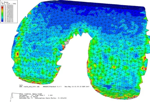 Figure 10Bone interface of the conventional implant under third load condition showing stress concentration along the sharp edgesBone interface of the conventional implant under third load condition showing stress concentration along the sharp edges