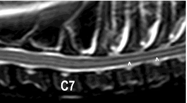 Figure 1. Example of a truncation artifact mimicking the central canal in a T2w sagittal image of the 