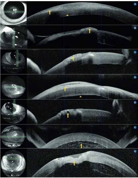 Figure 3 – Different anterior segment optical coherence tomography patterns in infectious keratitis