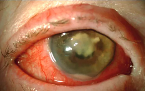 Figure 4 – flammatory membrane in the pupillary area (corresponding to Fig. showing temporal paracentral corneal thinning, hypopyon, an in-Citrobacter braakii keratitis