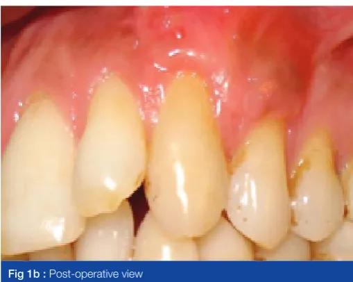 Fig 1a : Pre-operative photograph showing gingival recession with 14 