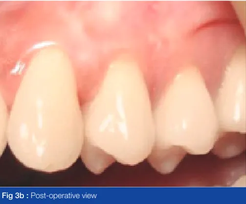 Fig 3b :  Post-operative view 