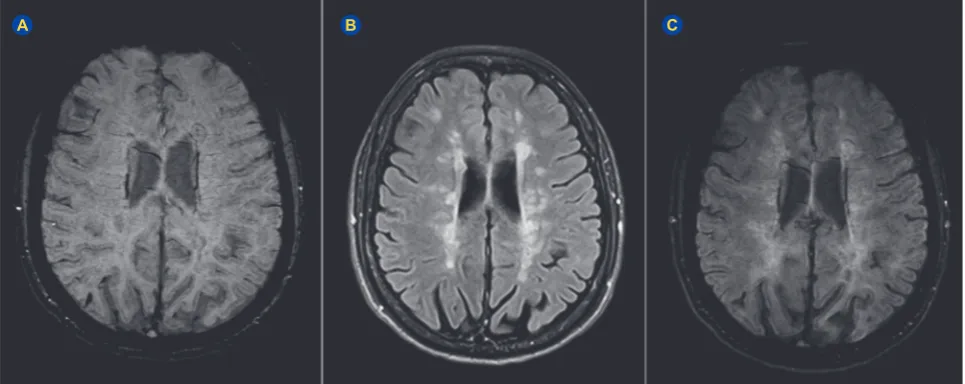 Figure 1 – (to be distributed along the course of deep medullary veins, a phenomenon that can be depicted in fused SWI-FLAIR images, contributing A) Susceptibility-weighted imaging (MIP)