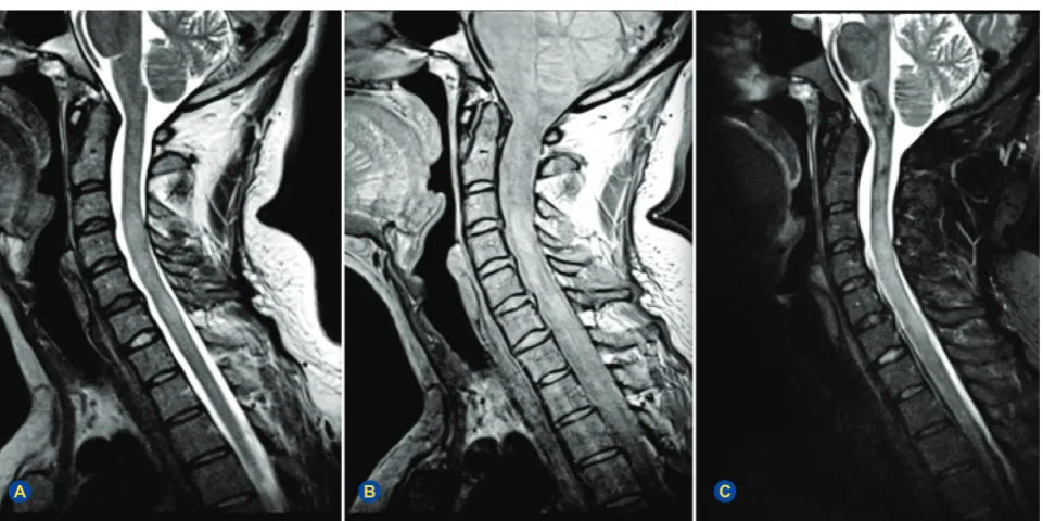 Figure 2 – Sagittal cervical spinal cord images. (A) T2-weighted fast spin-echo. (B) Proton-density (acquired at dual-echo)