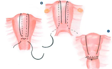 Figure 3 – Longitudinal sutures variations. (A) Nelson and Birch’s description of uterine compression sutures.32; (B) Marasinghe et al technique to avoid thread slipping over the uterine fundus.33; (C) Mansoura VV-suture.21,35Dashed lines represent the suture on the posterior aspect of the uterus.