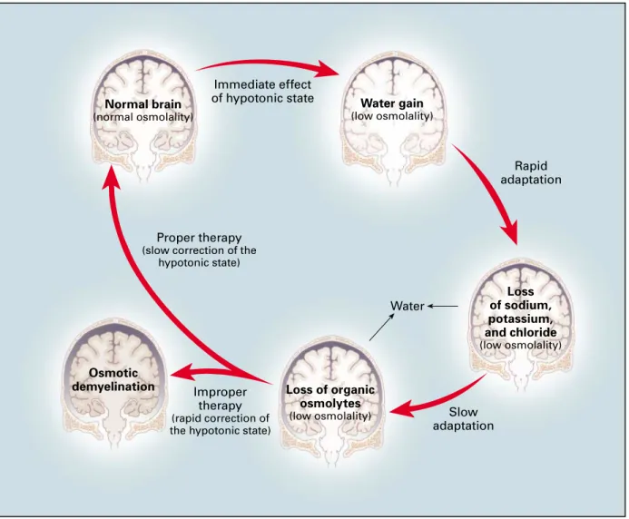 Figure 2.  Effects of Hyponatremia on the Brain and Adaptive Responses.