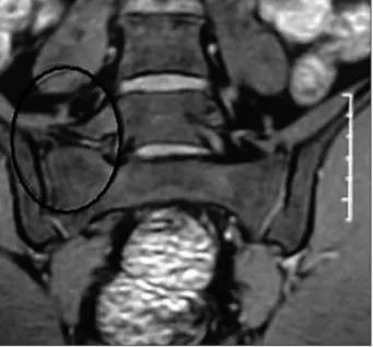 Fig 2. Coronal section magnetic resonance imaging of the lumbosacral  region demonstrating contact of the transverse mega-apophysis in  the right side of L5 with the sacrum (circle).