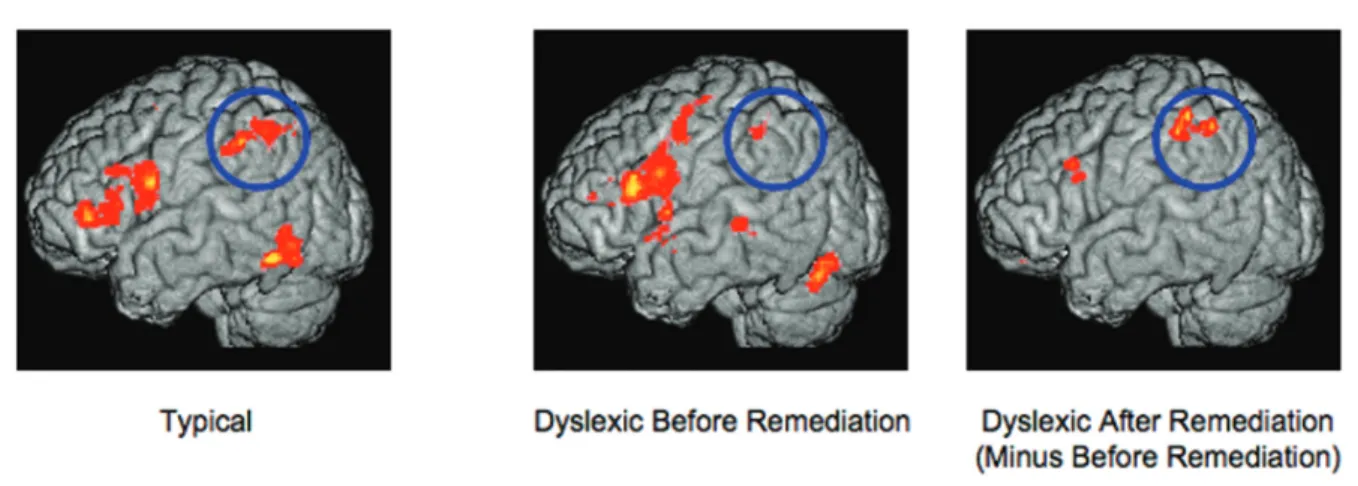 FIGURE 3. Remediation of dyslexia at the level of brain function. (1) Left-hemisphere areas active in typical readers