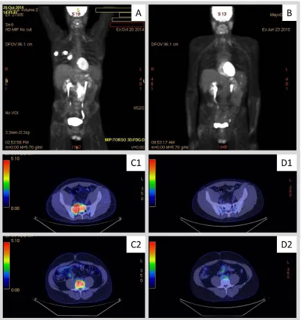 Figure 1: 18F-fluorodeoxy-glucose–positron-emission tomography (FDG-PET) images obtained to evaluate response to therapy with pembrolizumab