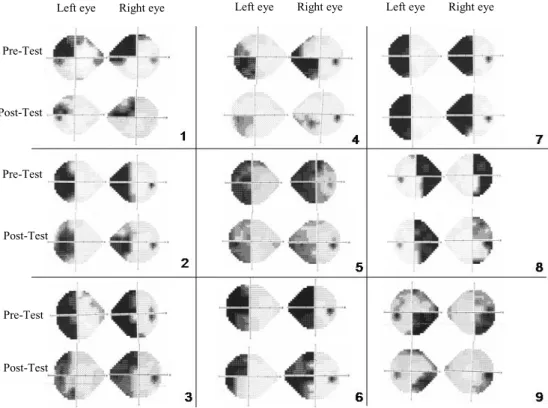 Fig. 1. For each patient, (a) Humphrey Automated Perimetry (24-2 Full Threshold program), from top to bottom: before training (VFT1), after training (VFT2) or (VFT3) for patients 2, 4, 5, 6, 8 and 9 who received an additional phase of training
