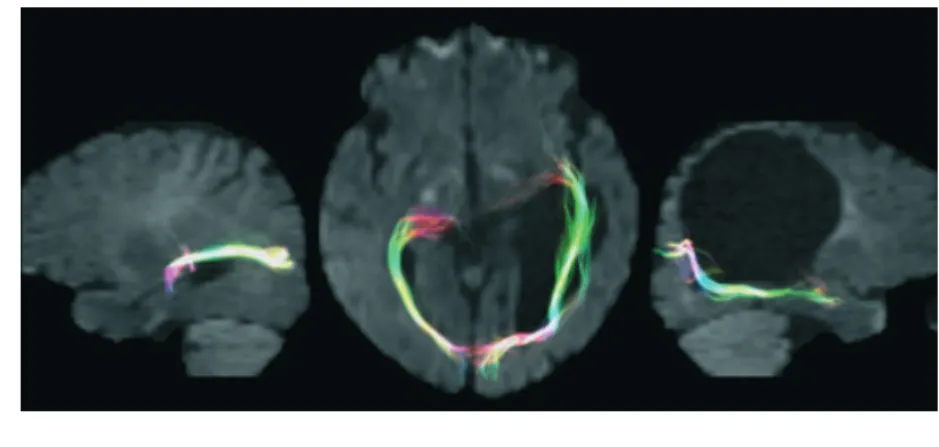 Figure 3: Diffusion tensor tractography of the optic radiations of a patient overlaid on a co-registered DW image