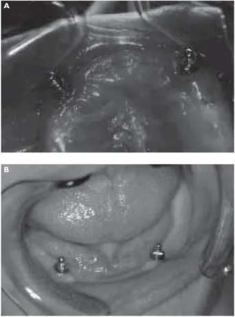 Figure 1 – (a) Ball attachments –  teeth 13, 23 – 3 years post insertion; 