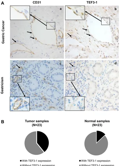 Figure 5: Frequent nuclear localization of TEF3-1 accompanied by CD31 expression in gastric cancer