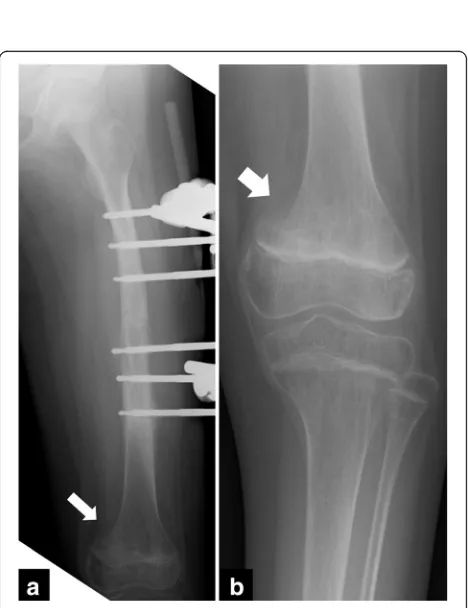 Fig. 4 Radiographs of the left femur at the first refracture at apin-site. (arrow) (a) the anteroposterior view, (b) the lateral view