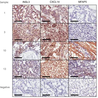 Figure 4: Immunohistochemical examination of INSL3, CXCL14 and MFAP5 in two stage 1 (1 and 3) and two stage 3 aGCT (10 and 13)